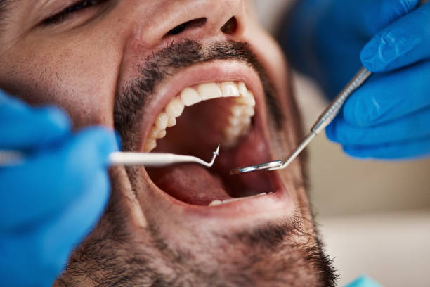 Best Knocked-Out Tooth (Avulsed Tooth) Treatment in Fort Hood, TX
